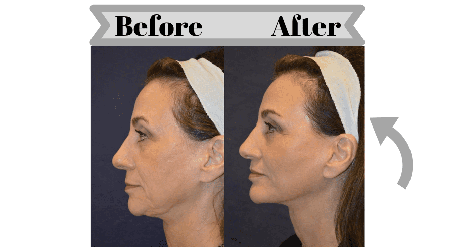 Facelift and Neck Lift Before and After