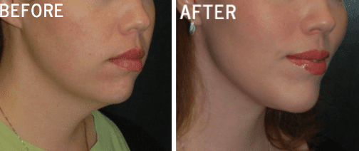 Cheek_lift_08.jpg-ba-img-blog