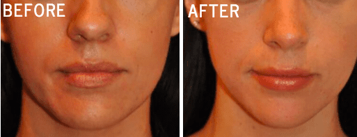 Rhinoplasty-25.jpg-ba-img-blog