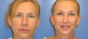 A Cheek Lift or Facelift for Natural-Looking Results - Dr. Jason B. Diamond