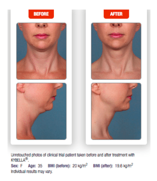 KYBELLA®: Nonsurgical Treatment for the Neck & Chin Area - Dr. Jason B. Diamond