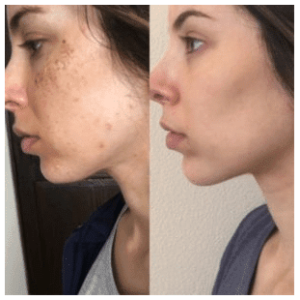 IPL Photo Facial Before and After Photos