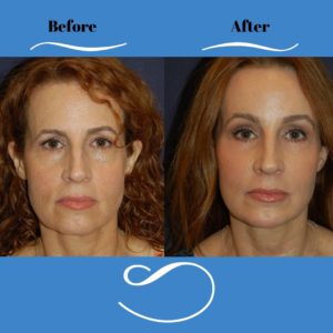 Female_Full_Face_Rejuvenation_Front-blog-ba-img