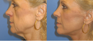 When Should I Get a Facelift? - Dr. Jason B. Diamond