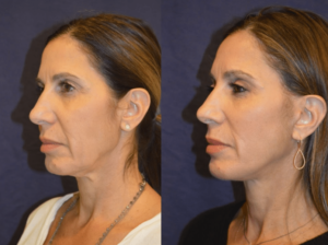Dr. Diamond - Chin implant, fat grafting, brow lift, facelift