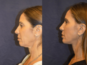 Dr. Diamond - Chin implant, fat grafting, brow lift, facelift.
