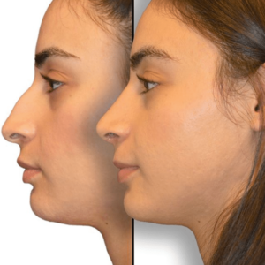 What Is the Best Technique for My Rhinoplasty? - Dr. Jason B. Diamond