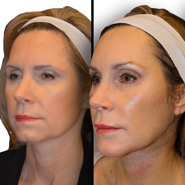 Facelift Before and After Photos