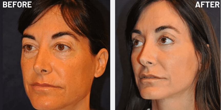 full-face-rejuvenation-patient-13