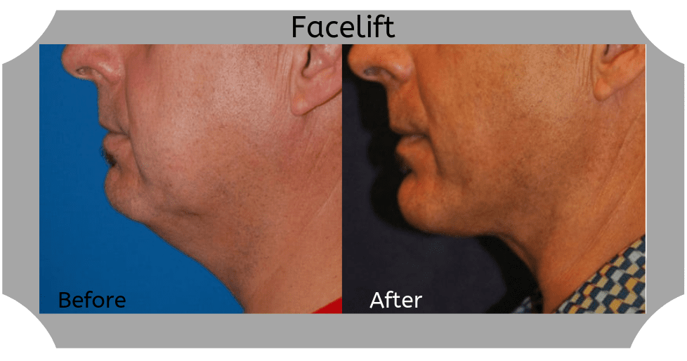 Male-Facelift-05-Blog-BA-Img copy (1)