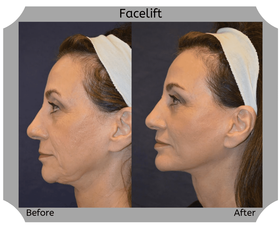 facelift-2-Blog-BA-Img copy (1)