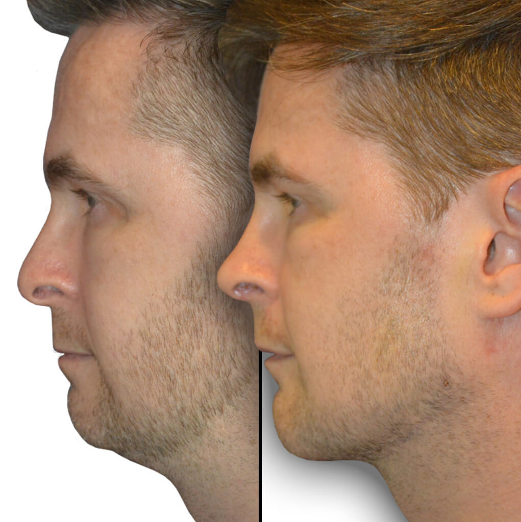 Before and After Patient Revision Rhinoplasty, Chin Implant & Jaw Implant (The Diamond Tripartite)
