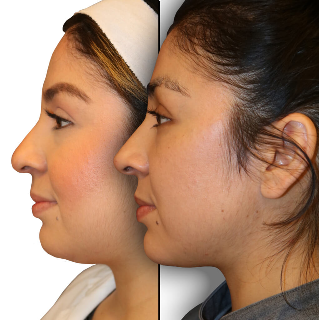The Diamond Facial Sculpting Procedures