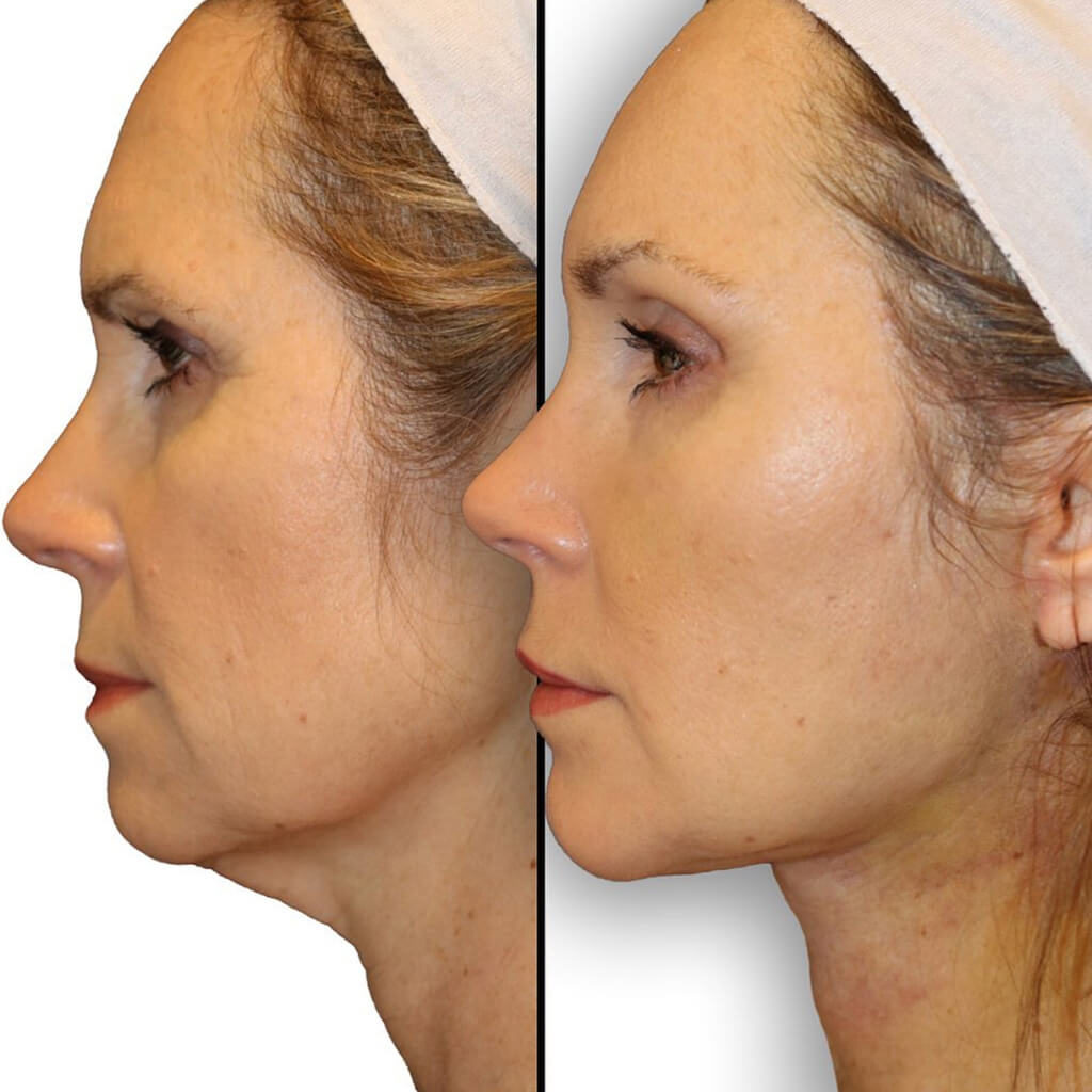 Diamond Facial Rejuvenation with a Facelift & Necklift before and after results