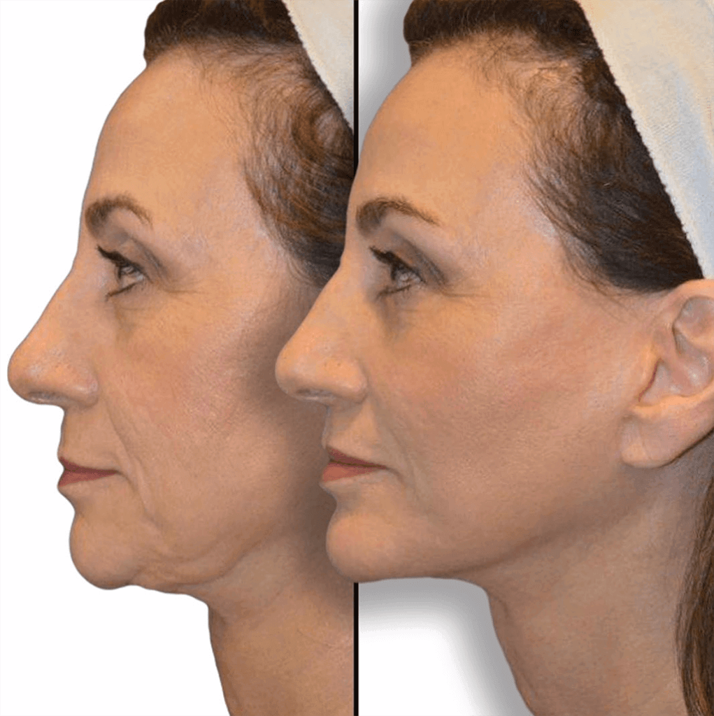 Before and after Female, Revision Facelift, Neck Lift, Chin Augmentation, Lip Lift, Facial Fat Grafting