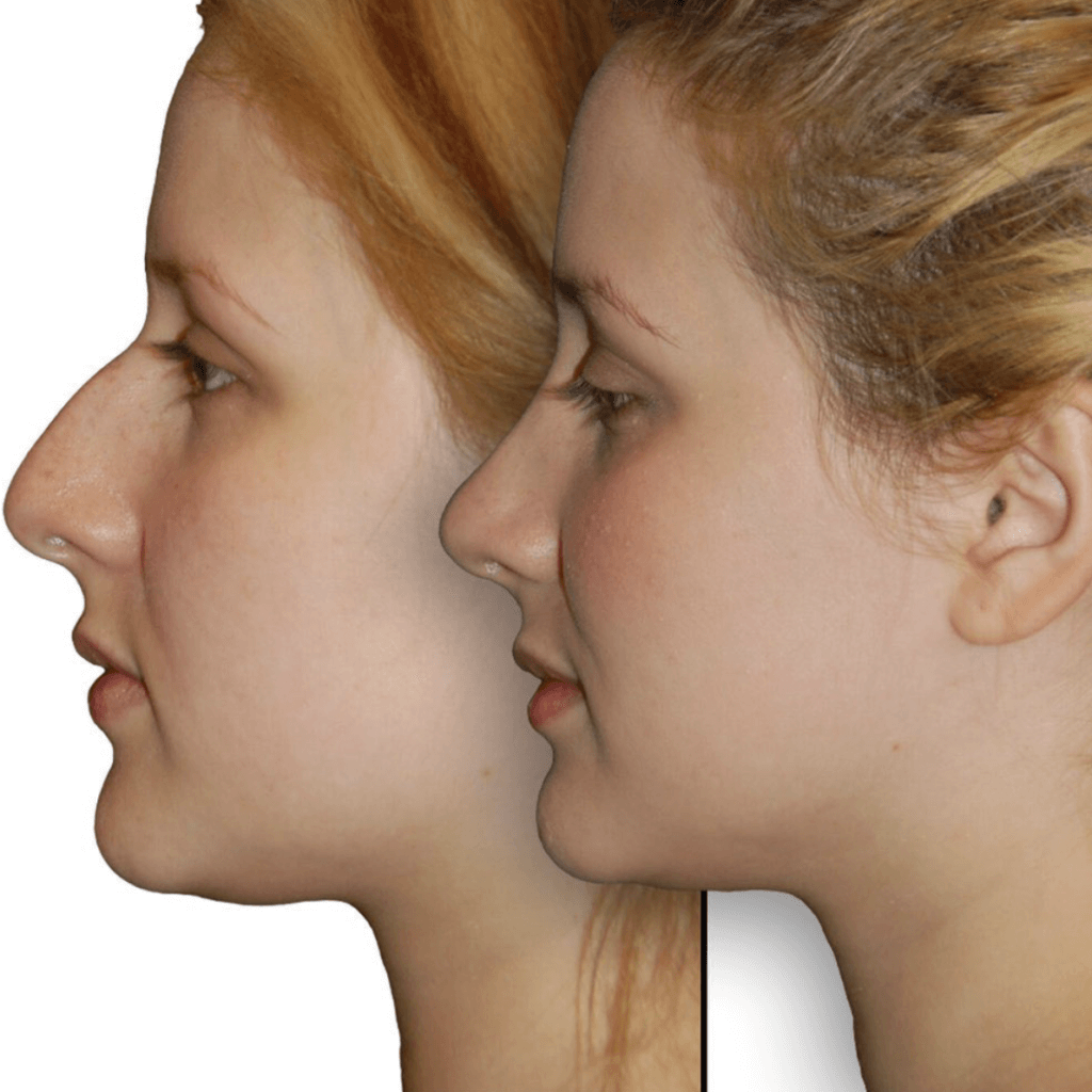 Before and after Primary Rhinoplasty Surgery
