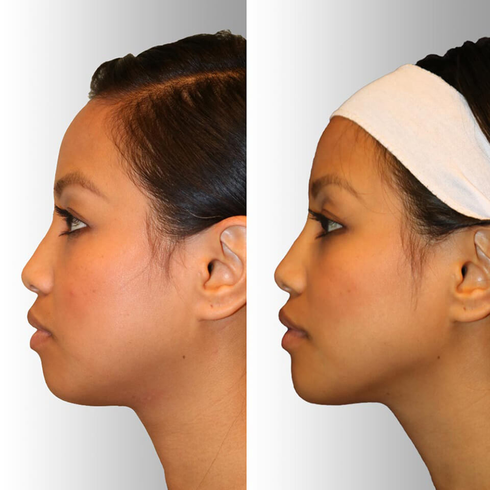Diamond Facial Sculpting™