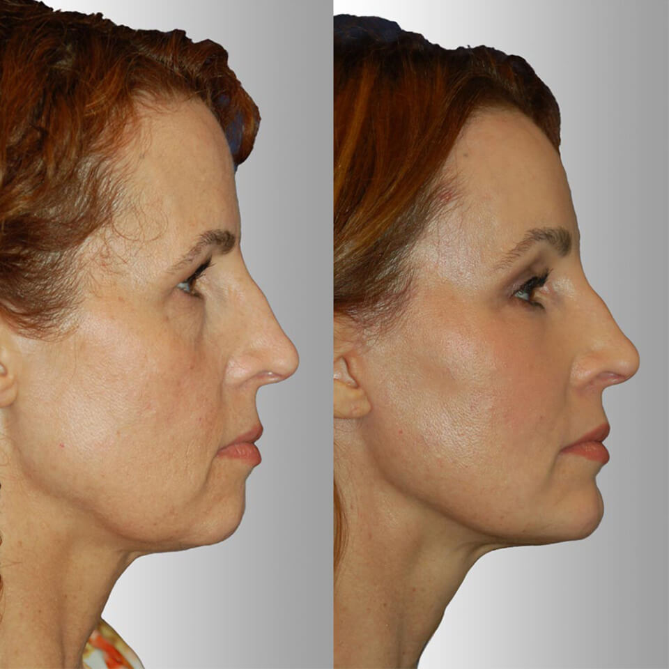 Facial Rejuvenation before and after