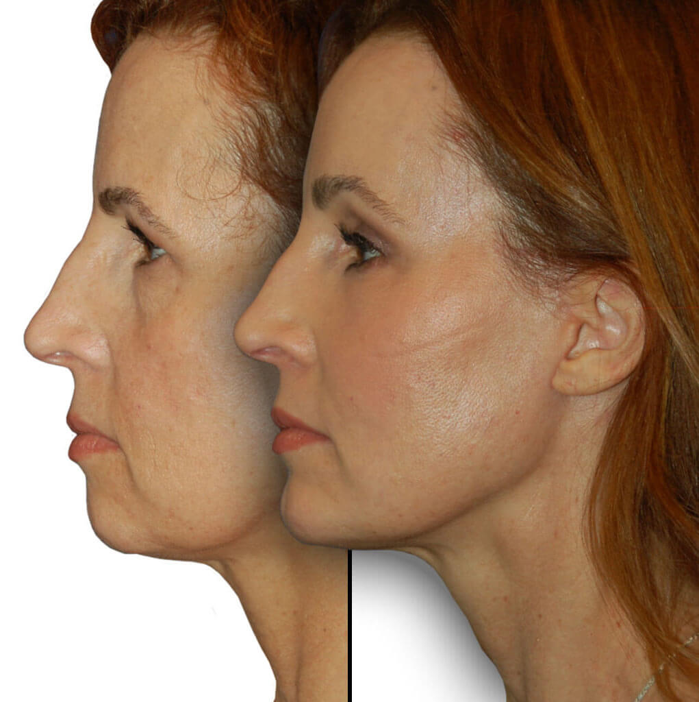 Before and After Patient: Female, Upper Blepharoplasty, Lower Blepharoplasty, Facelift, Neck Lift, Brow Lift, Chin Augmentation, Facial Fat Grafting, CO2 Laser Rejuvenation.