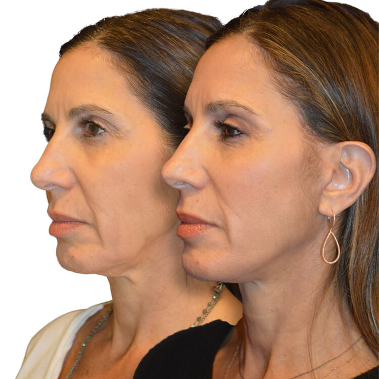Before and after Female, Facelift, Brow Lift, Chin Implant, and Facial Fat Grafting