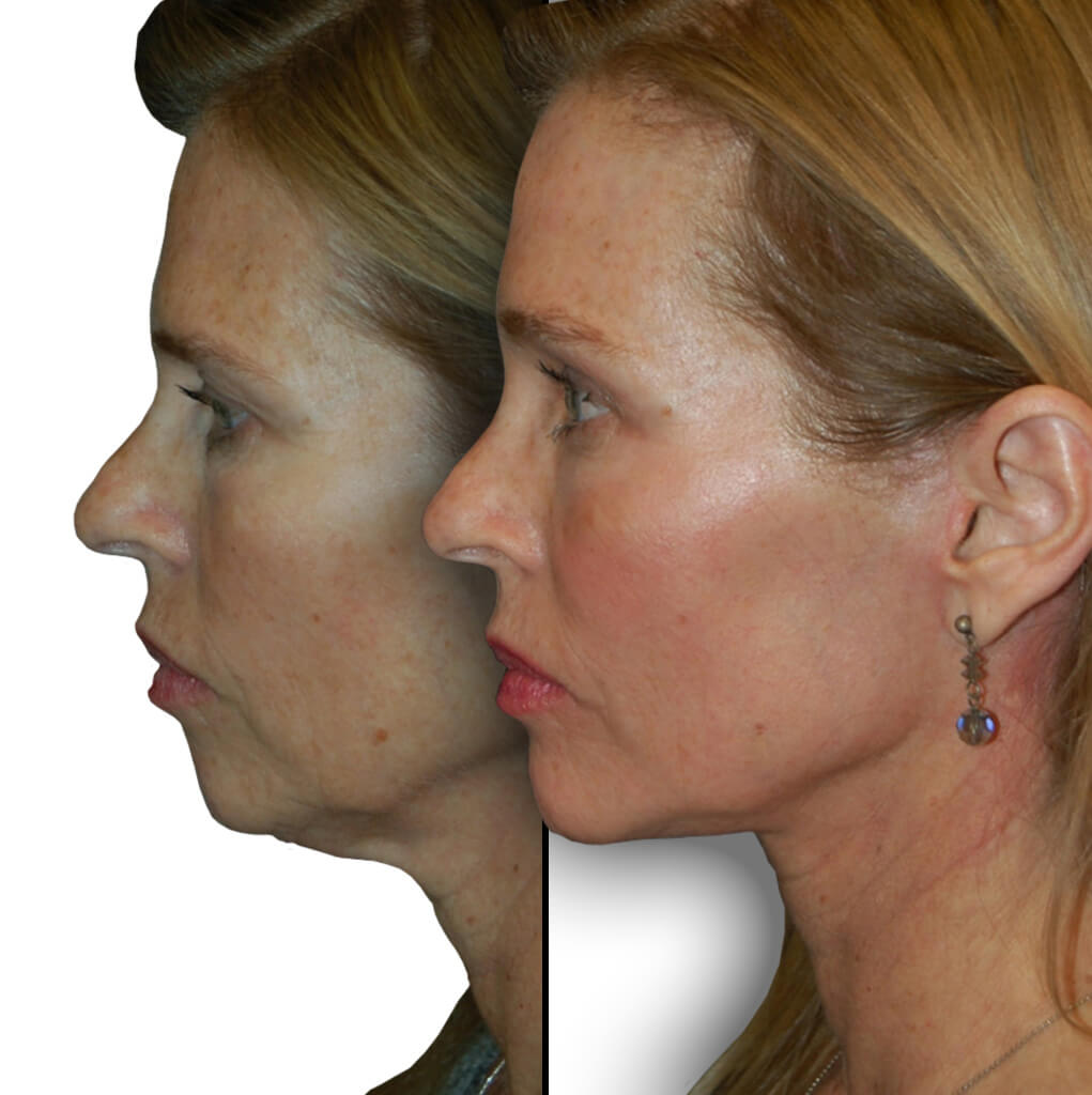 Before and after patient Female, Facelift, Neck Lift, Diamond Facial Rejuvenation, and Facial Fat Grafting.