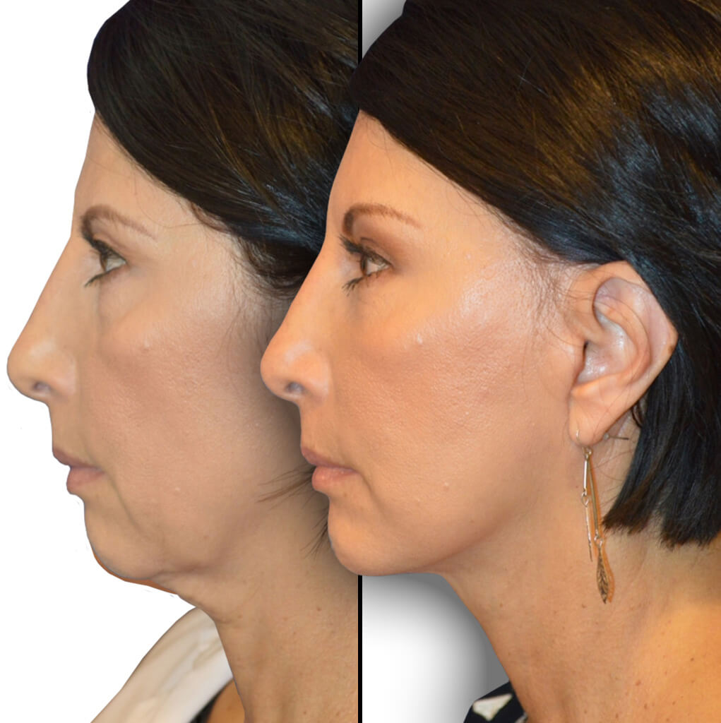 Before and After Patient: Female, Brow Lift, Facelift, Neck Lift, Chin Augmentation, Upper Blepharoplasty, Lower Blepharoplasty, Facial Fat Grafting
