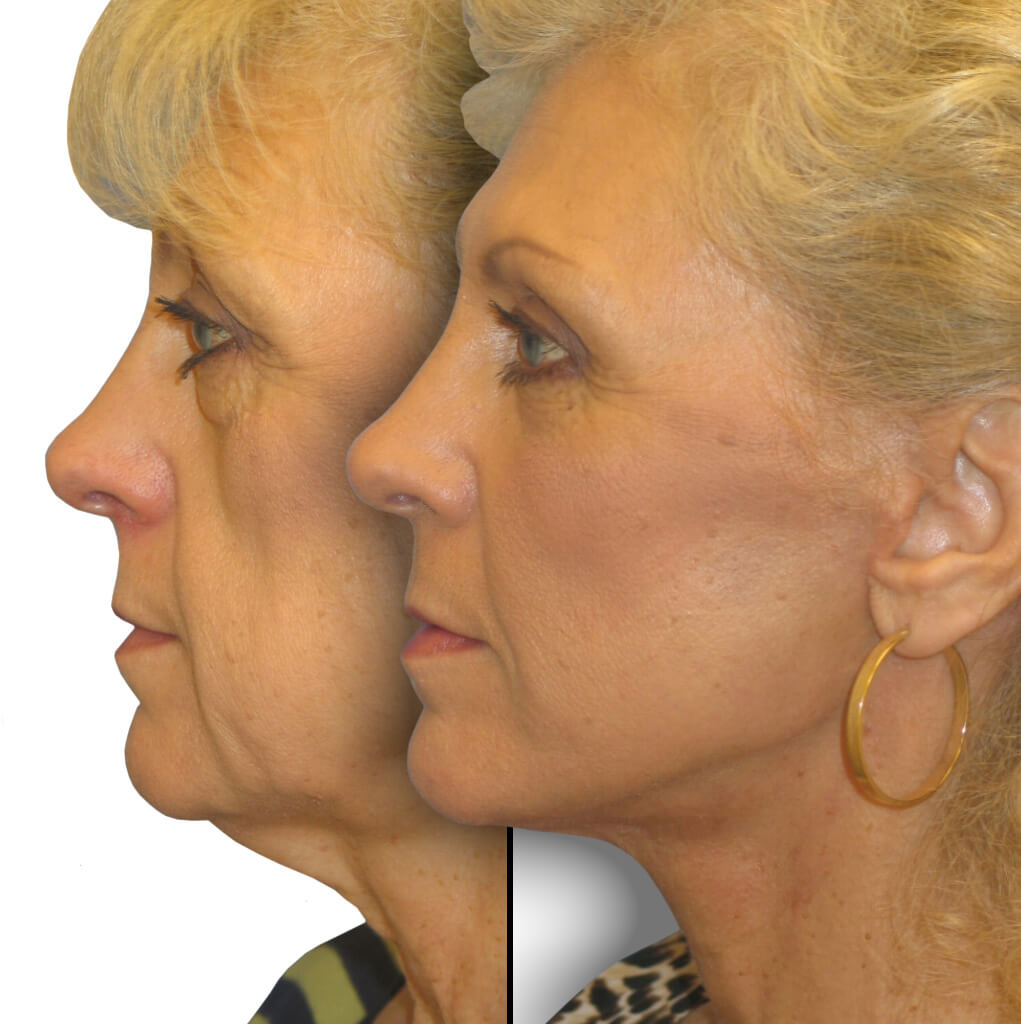 Before and After Patient: Female, Lower Blepharoplasty, Facelift, Neck Lift, Brow Lift, Facial Fat grafting, Cheek Lift, Chin augmentation
