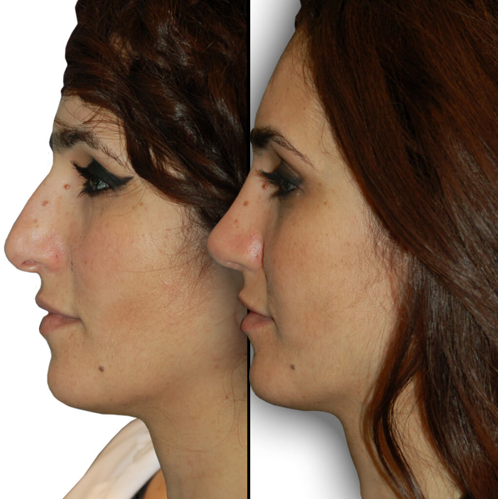 Lip Augmentation Procedures