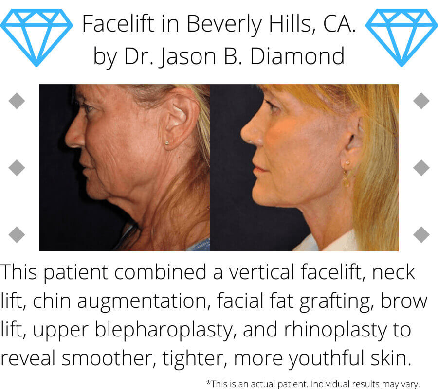 Facelift patient results