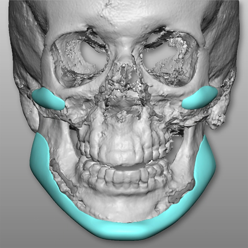 The Diamond Tripartite™ implant imaging