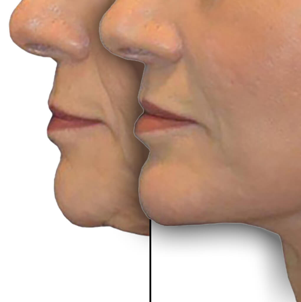 Before and After Patient: Female, Lip Lift, Revision Facelift, Neck Lift, Chin Augmentation and Facial Fat Grafting