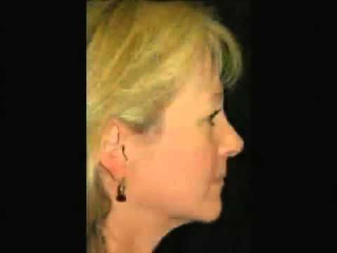 Dr Jason Diamond -- Miraculous Midface Rejuvenation