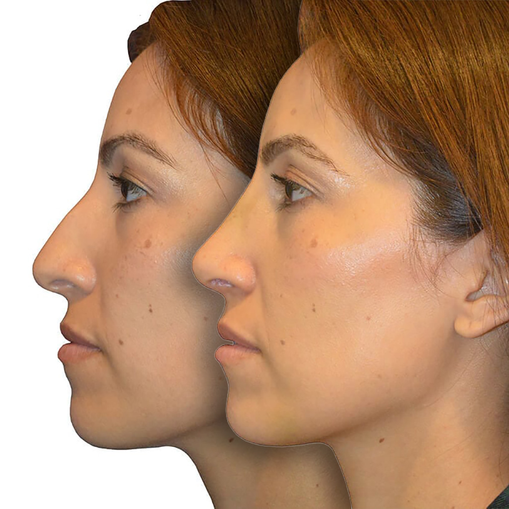 Before and after patient results