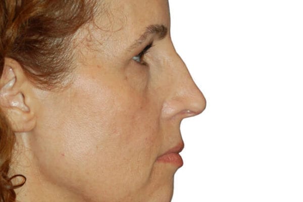 Brow Lift Patient 02 - Before - 1 Carousel Thumbnail