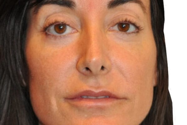 Brow Lift Patient 03 - After - 1 Carousel Thumbnail