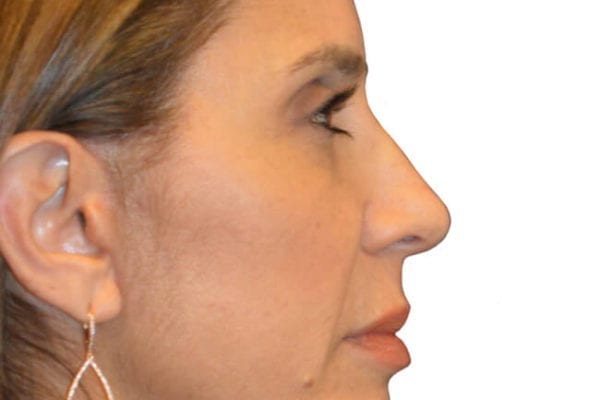 Brow Lift Patient 04 - After - 1 Carousel Thumbnail