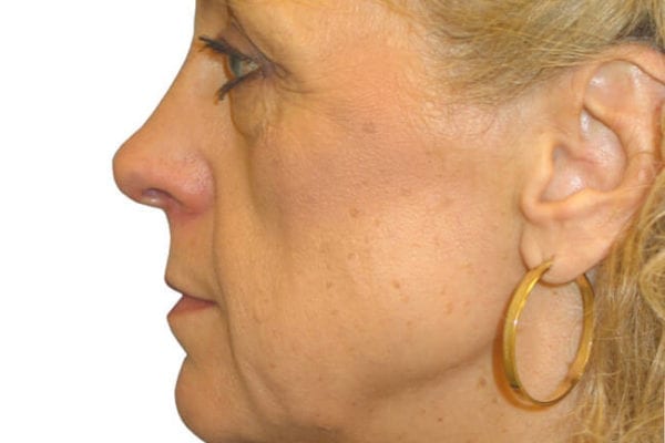 Brow Lift Patient 05 - Before - 1 Carousel Thumbnail