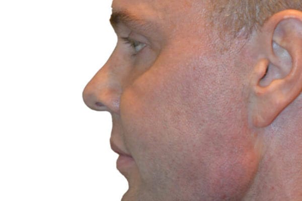Chin Augmentation Patient 14 - After - 1 Carousel Thumbnail