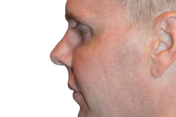 Chin Augmentation Patient 14 - Before - 1 Carousel Thumbnail