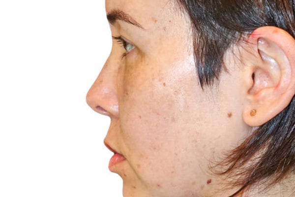 Chin Augmentation Patient 12 - After - 1 Carousel Thumbnail