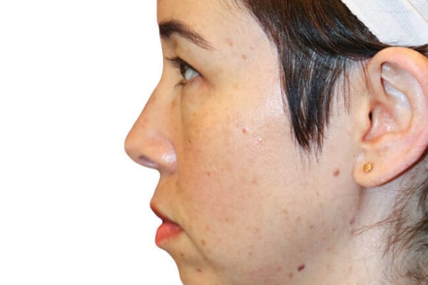 Chin Augmentation Patient 12 - Before - 1 Carousel Thumbnail