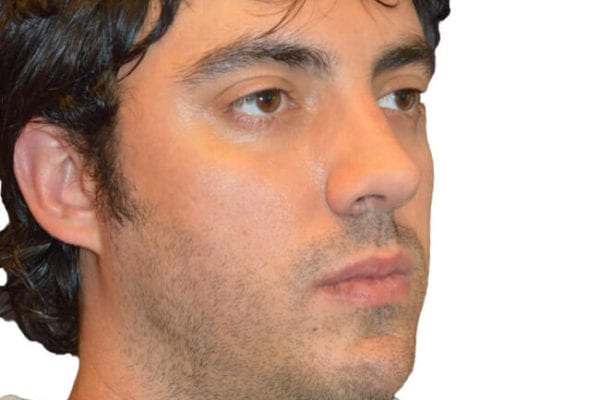 Chin Augmentation Patient 13 - Before - 1 Carousel Thumbnail