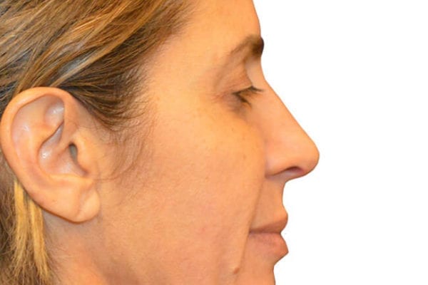 Chin Augmentation Patient 02 - Before - 1 Carousel Thumbnail