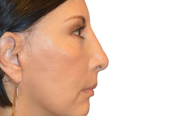 Chin Augmentation Patient 03 - After - 1 Carousel Thumbnail