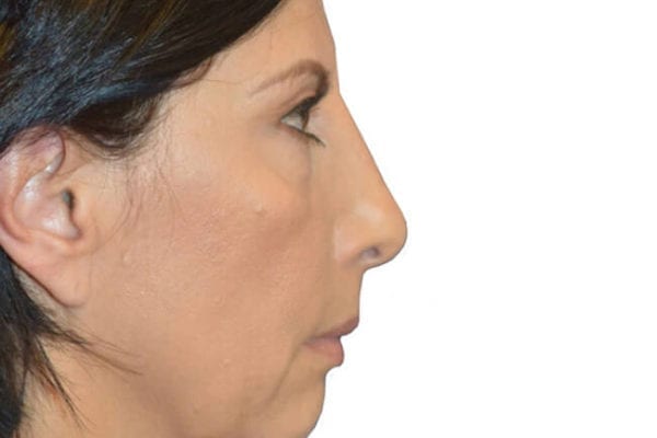 Chin Augmentation Patient 03 - Before - 1 Carousel Thumbnail