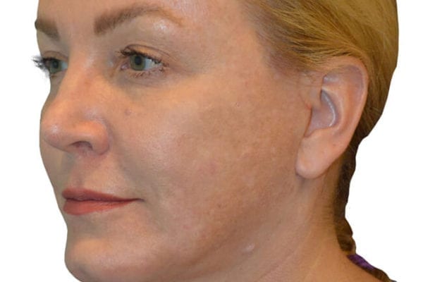 Chin Augmentation Patient 05 - After - 1 Carousel Thumbnail