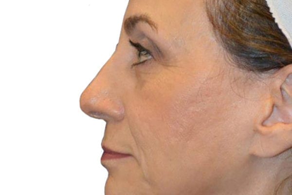 Chin Augmentation Patient 06 - Before - 1 Carousel Thumbnail