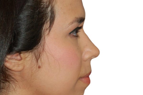 Chin Augmentation Patient 08 - Before - 1 Carousel Thumbnail