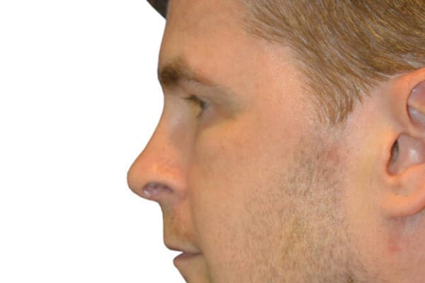 Chin Augmentation Patient 09 - After - 1 Carousel Thumbnail