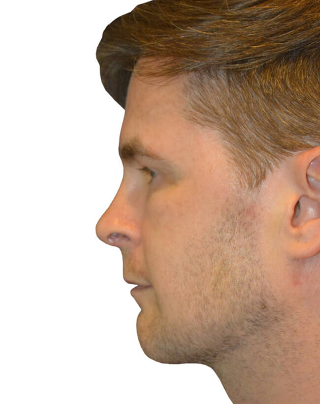 Patient After Chin Augmentation